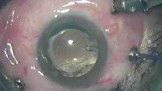 MNEMONIC - Indications for Vitrectomy!