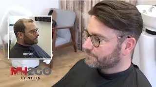 Hair Replacement FITTING VIDEO/ LOUIE &ndash; Hair loss, Baldness, Hair Wigs, Hair Toupees, Hair Pieces