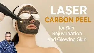 Laser Carbon Peel: Secret to Instant Glow & Skin Rejuvenation!