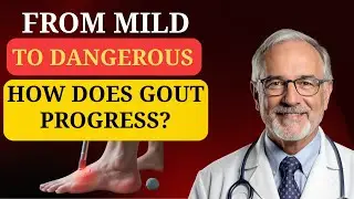 Gout Stages Explained: Symptoms, Progression & How to Prevent Dangerous Complications