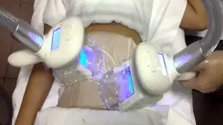 Double cryolipolysis+cavitation+RF multifunction slimming machine