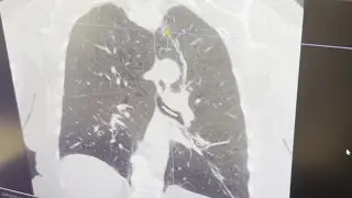 Montana doctor says early detection key to preventing lung-cancer deaths