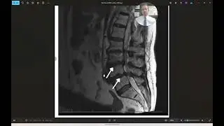 Half a Millimeter Can Be the Difference Between Life and Death or Pain and Misery