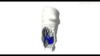 Medtronic CoreValve simulation
