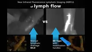 6d Tape Proved Effect On Lymph Flow