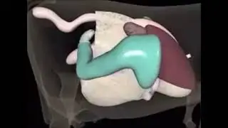 Tratamiento Desplazamiento abomaso
