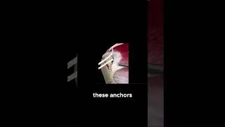 Arthroscopic Surgery  for Rotator Cuff Tear