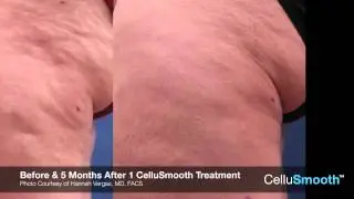 CelluSmooth Sciton | A Breakthrough in Body Contouring Laser Liposuction Cleveland, Ohio