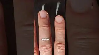 Can Simple Home Remedies Rescue Your Fingernail From Infection?