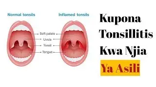 Njia Ya Asili Ya Kupona Tonses(Mafindofindo)//Tonsillitis