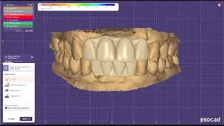 Upper & lower anteriors designing for pmma prosthesis in Exocad elefsina  - DIGITAL DENTISTRY