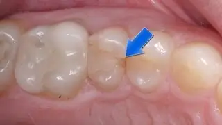 Chipped Decayed Weak Teeth- CEREC Omnicam Dental Crowns Best Treatment