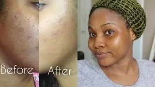 How I Keep My Skin Clear And Acne Free