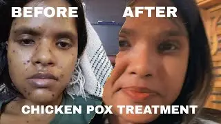 CHICKEN POX TREATMENTS PART 2 | #chickenpox #vlog #treatment