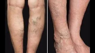 Nanovein Crema Romania, Forum, Farmacia, Preț, Compozitie, Varice