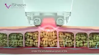 Vshape Body Cntouring Machine | Inner ball roller Therapy Machine
