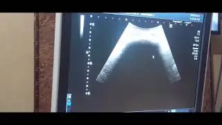 Foreign body (Plastic material in stomach@ultrasoundboardreview @ultrasoundlecturesbydrsale9036