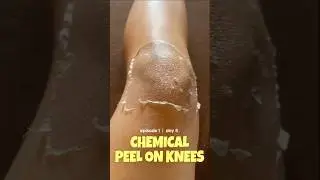 Chemical peel on knees Day 5🌸✨ #sristydutta #skincare #beauty #chemicalpeel