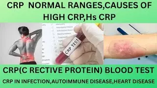 CRP(C REACTIVE PROTEIN).CRP BLOOD TEST.NORMAL RANGE,CAUSES OF HIGH CRP,Hs CRP ,HOW TO REDUCE CRP?
