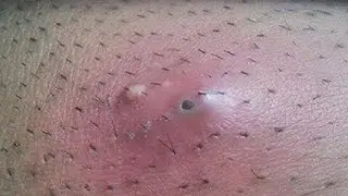 HOW TO GET RID OF RAZOR BUMPS AND INGROWN HAIRS EXTREMELY EASY