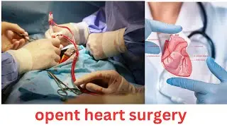 Awake cardiac surgery treatment ।।Real open heart surgery  treatment usa ।। bd # heart # surgery