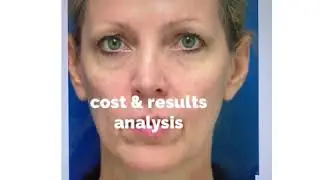 Dr. Renato Calabria Offers an Analysis of Fillers Vs. the One Stitch Facelift