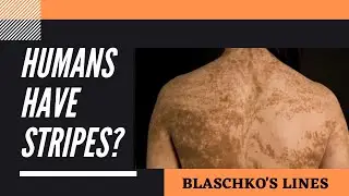 Линии Блашко. Есть ли у людей полосы, как у тигра или зебры?