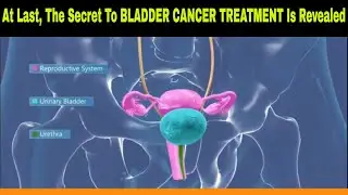Unlock the Secret to BLADDER CANCER Treatment and Give Yourself a Fighting Chance!