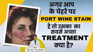 चेहरे पर Port Wine Stain का सबसे अच्छा Treatment क्या है? Birthmark Treatment in Delhi,Dr. PK Talwar