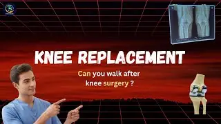 Knee Replacement ke Baad Chalna Kab Safe Hai? 🚶 | Physiotherapy Recovery Guide in Hindi