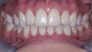 Inman Aligner Before and After Case Photo Slideshow- Azure Dental- Formby, Liverpool
