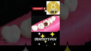 Dentist&rsquo;s POV #shorts #dentist #cavity #education