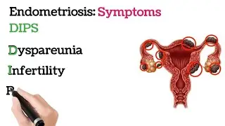 Endometriosis Symptoms