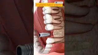 İmplant nedir ve nasıl yapılır?İmplant, &ccedil;ene kemiğine yerleştirilen ve protezlere destek i&ccedil;in