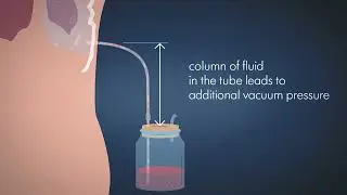 Explaining Benefits of Regulated Suction in Drainage Systems | Chest Drainage