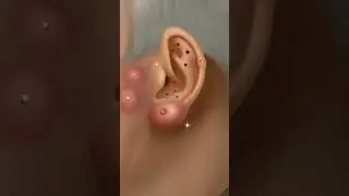 #asmr Pimple Blackheads & Sebaceous Cyst Removal #ear #pain #animation #shorts