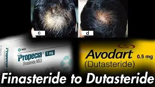 Dutasteride Loading Phase According to Literature