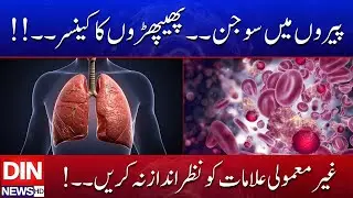 Swelling in Legs and Lung Cancer Warning &mdash; Symptoms You Should Not Ignore | Din News HD