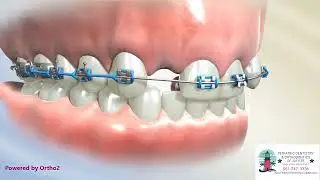 Pontics for missing laterals