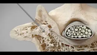 DePuy Synthes Sentio MMG System - Ghost Medical Animation