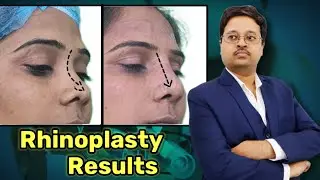 Rhinoplasty Results After 10 days ||  Nose Job In Kolkata || Dr. Jayanta Bain plastic surgeon