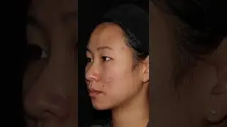 Non-surgical skin tightening in Vancouver
