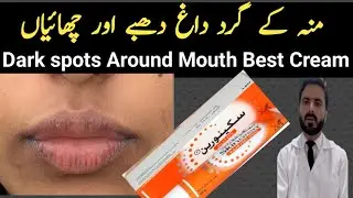 Skinoren cream for perioral hyperpigmentation | dark spots around Mouth Treatment 