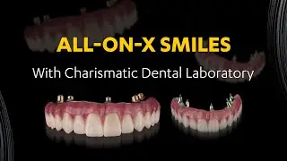 All-on-X and The 2 Step Technic by Charismatic Dental Laboratory