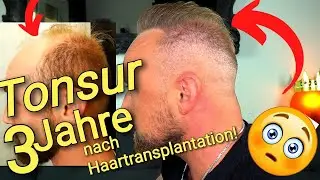 Tonsur & Spender 3 Jahre nach Haartransplantation Ergebnis | Enttäuscht ?