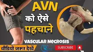 AVN hip ko kese pehchane. AVN hip Treatment without surgery. कुल्हे का दर्द  #avascularnecrosisofhip