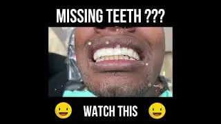Missing Teeth??? Affordable Snap On Smile You can Eat and Drink with | Removable Clip On Veneers USA