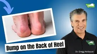 Bump on Back of Heel