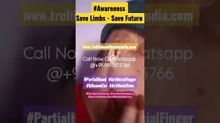 Partial Hand Amputee Best Treatment | Microtia Or Ear Amputee Best Treatment  @+919910213766 Delhi
