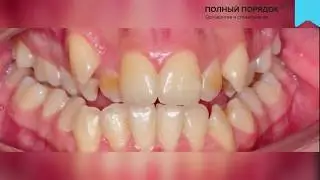 Длительное лечение  металлическими брекетами Damon Q c удалением